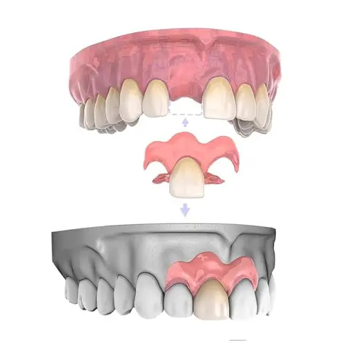 Removable Dental Prosthetics (1 Tooth)